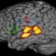 La dyslexie serait liée à un défaut de connexion dans le cerveau